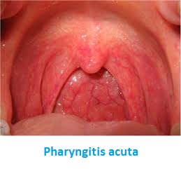 pharyngitis-acuta